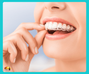 A woman putting Invisalign clear aligners in her upper teeth while smiling.
